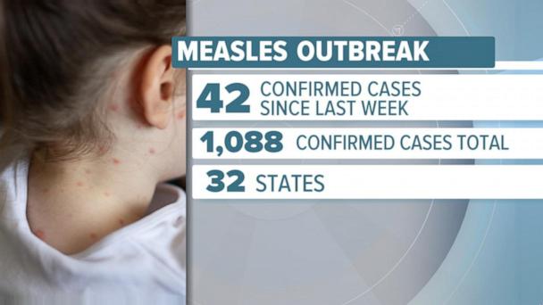 Measles cases top 1,000 in US