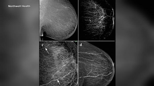 New potential use for mammograms