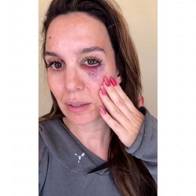 Christy Carlson Romano opens up about being shot in the face