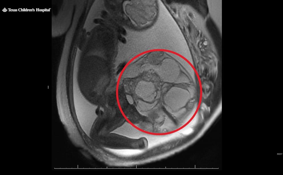 PHOTO: Adalida Tyler’s sacrococcygeal teratoma is seen in an ultrasound photo shared by Texas Children’s Hospital.