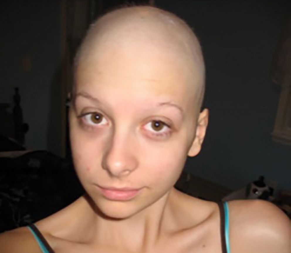 PHOTO: Caitlin Nespoli with a shaved head after chemotherapy at her home in Massapequa, N.Y., on September 9, 2008.