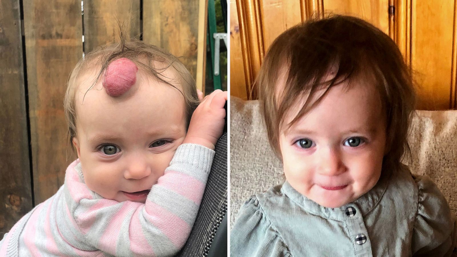 PHOTO: Chloe McKnight was born with a hemangioma on the top of her forehead. In these two images, she is pictured before and after undergoing surgery to remove it.