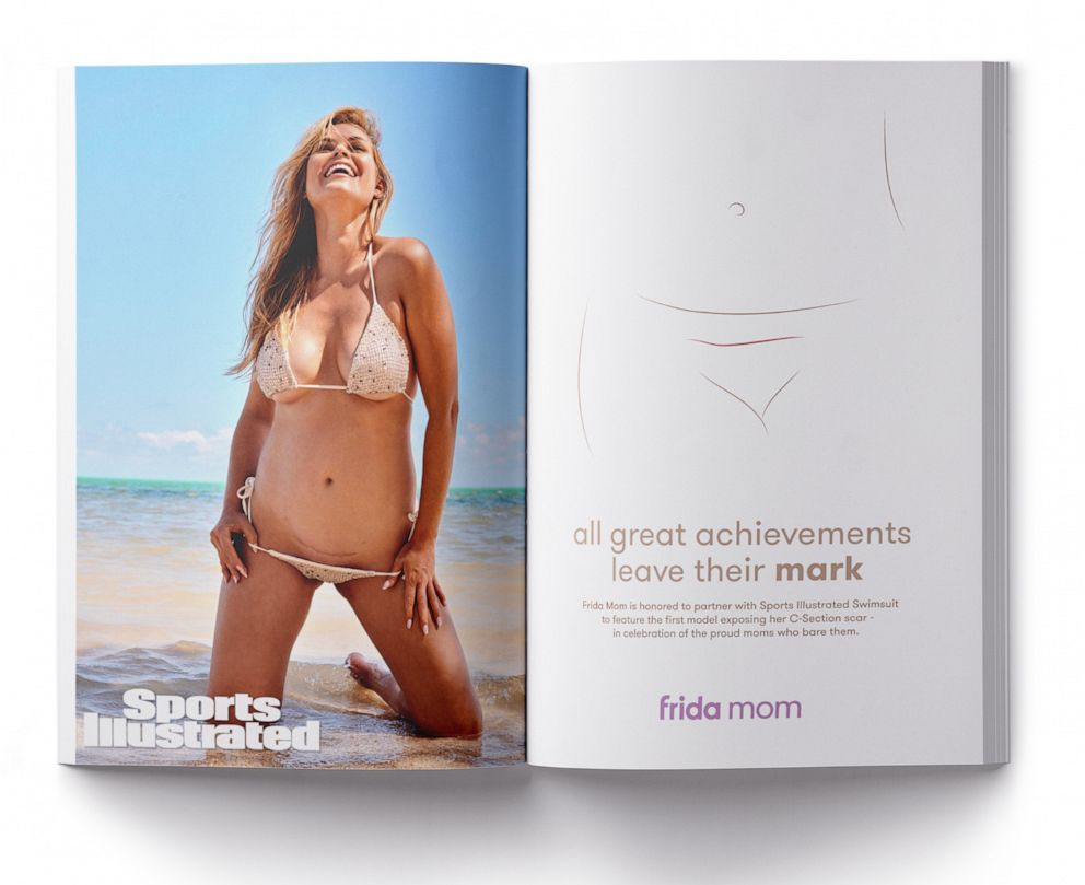PHOTO: Sports Illustrated Swim debuts its first-ever photos of a model showing her C-section scar.
