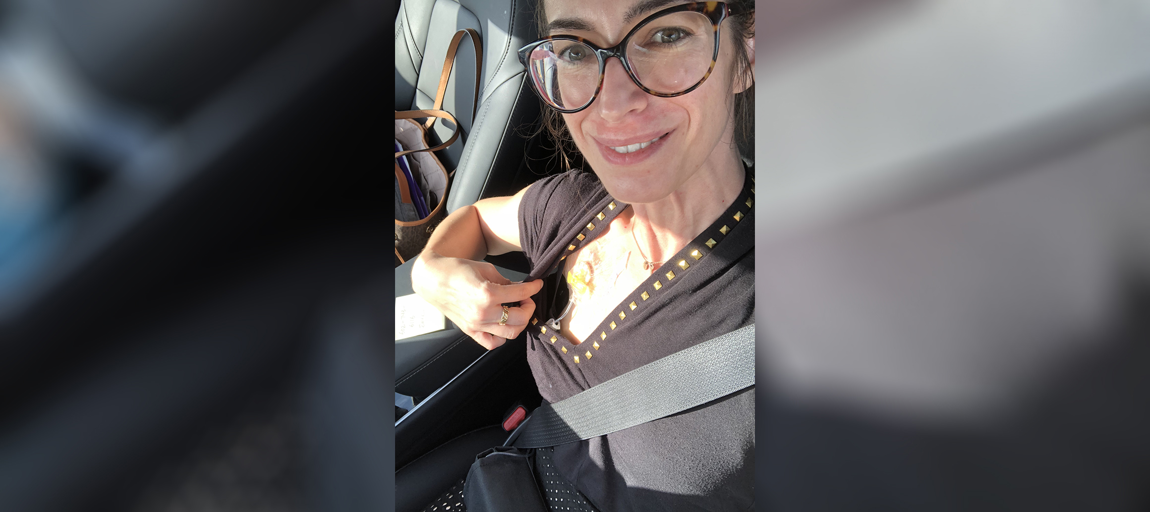 PHOTO: Dr. Lauren Juyia received chemotherapy treatment for colorectal cancer through a port, near her right shoulder, as she shows in this selfie.