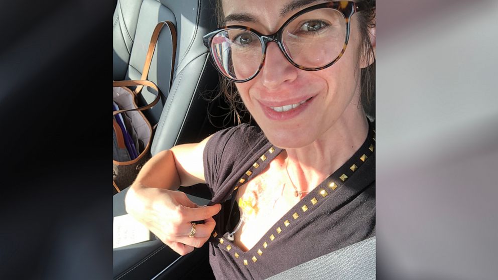 PHOTO: Dr. Lauren Juyia received chemotherapy treatment for colorectal cancer through a port, near her right shoulder, as she shows in this selfie.