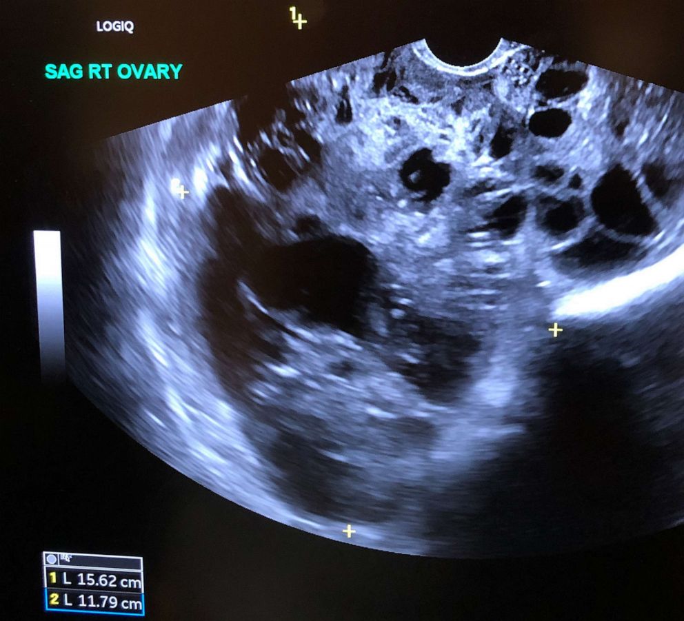 PHOTO: Juyia's right ovary at one time, had grown in size, to about 16 centimeters, as seen in this ultrasound. In contrast, the size of a normal ovary is usually about 2 centimeters.