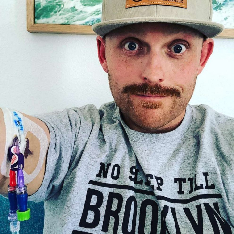 PHOTO: Travis Snyder, of California, is waiting for a bone marrow donation as he continues to fight acute myeloid leukemia.