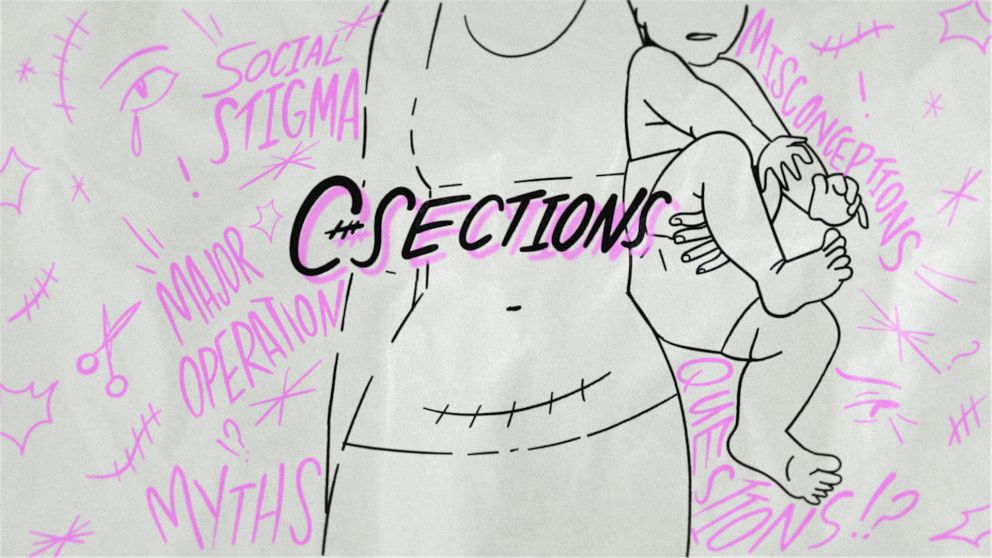 10 Common C-Section Delivery Myths Debunked: The Realities Of The