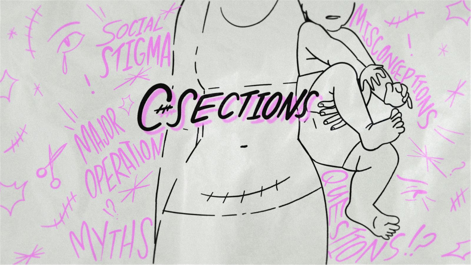 A C-section is an increasingly common way to give birth in the United States, but one that still faces misconceptions.