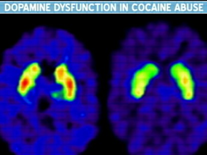 VIDEO: Hope for Addicts