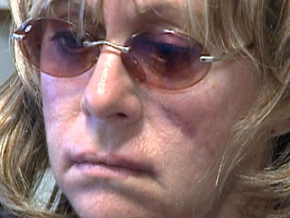 VIDEO: Heres the tale of a woman who used inexpensive, do-it-yourself plastic surgery.