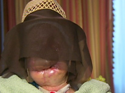 VIDEO: Carla Nash After the Chimp Attack