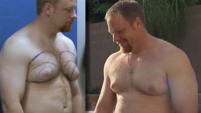 Male Breasts Surgery Offers New Appearance And Outlook Abc News