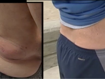 VIDEO: A new procedure could potentially get rid of body fat.