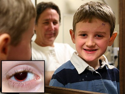 Medical Miracle: Prosthetic Iris