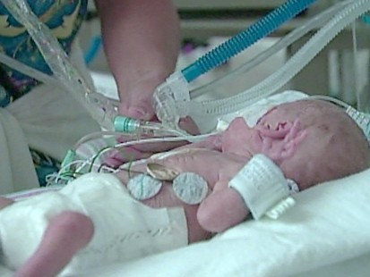Extreme Preemies Might Have Higher Autism Risk