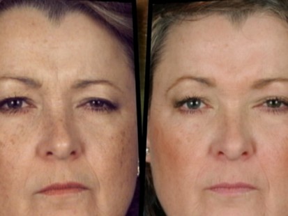 VIDEO: Plastic surgery could bring relief to millions people who suffer from headaches.