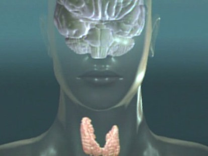 VIDEO: Dr. Oz offers insight into this common hormonal disorder.