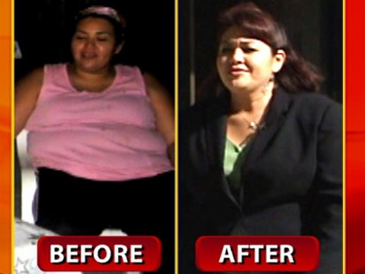 VIDEO: A new procedure shrinks the stomach without making an incision.