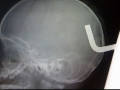 VIDEO: Miraculous Brain Surgery: Toddler Impaled