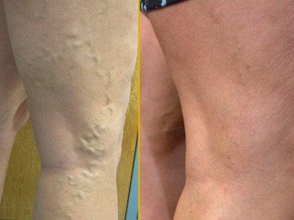 VIDEO: A new procedure can remove the bulging veins in 15 minutes.