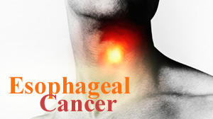 cancer esophageal symptoms throat natural causes health treatment common abc diagnosis illustration hides rare shares