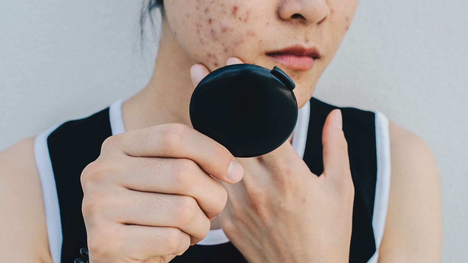 Acne Awareness Month: Shop these dermatologist-approved skin care