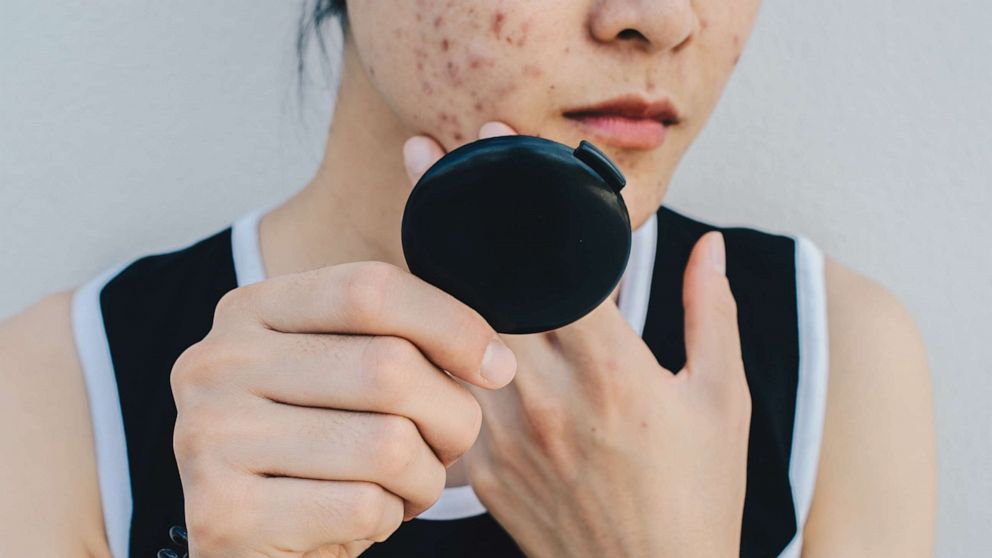 A female with acne is seen in an undated stock photo.