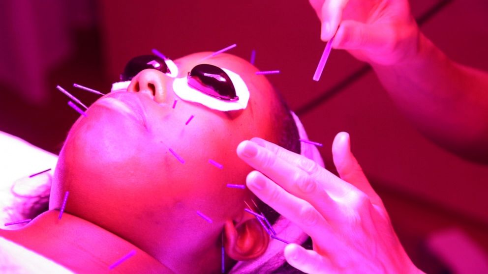 PHOTO: Digital style and beauty reporter Jacqueline Laurean Yates tried facial acupuncture to give the treatment celebrities love a true test drive. 