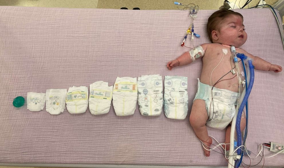 PHOTO: Addy spent the first two years of her life in the hospital. Here, she's pictured at nine months alongside the various diapers she grew out of.