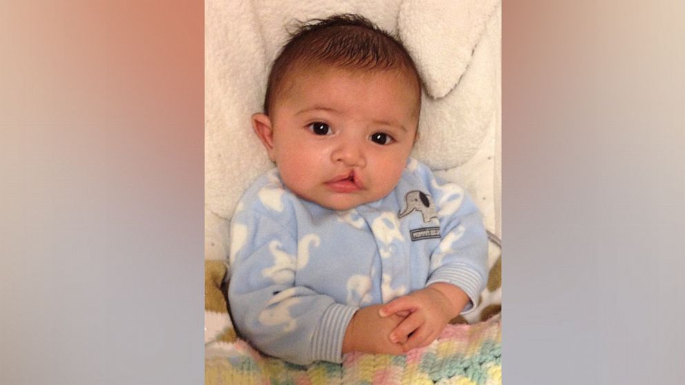 Lauren Onishi's son Adriano was born with a cleft lip and had to undergo multiple surgeries.