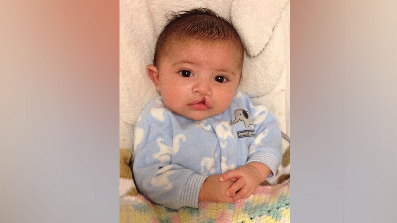 PHOTO: Lauren Onishi's son Adriano was born with a cleft lip and had to undergo multiple surgeries.