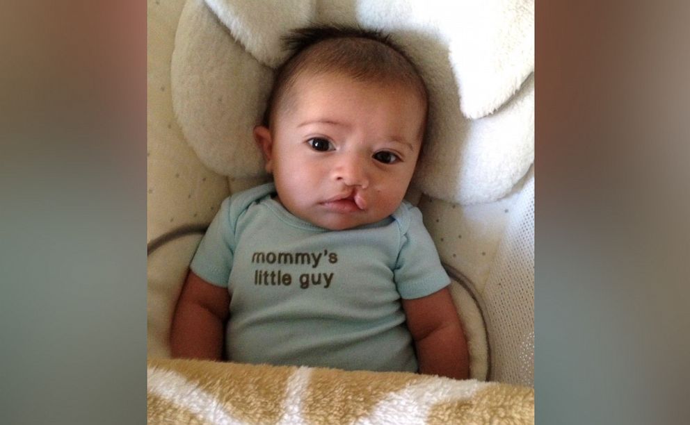 PHOTO:  Lauren Onishi found out when she was three months pregnant that her son had a cleft lip.