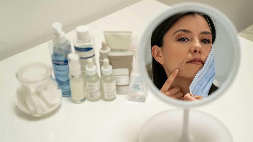 PHOTO: In this undated file photo, a woman struggles with mask related acne on her chin after wearing face masks during the COVID-19 pandemic.