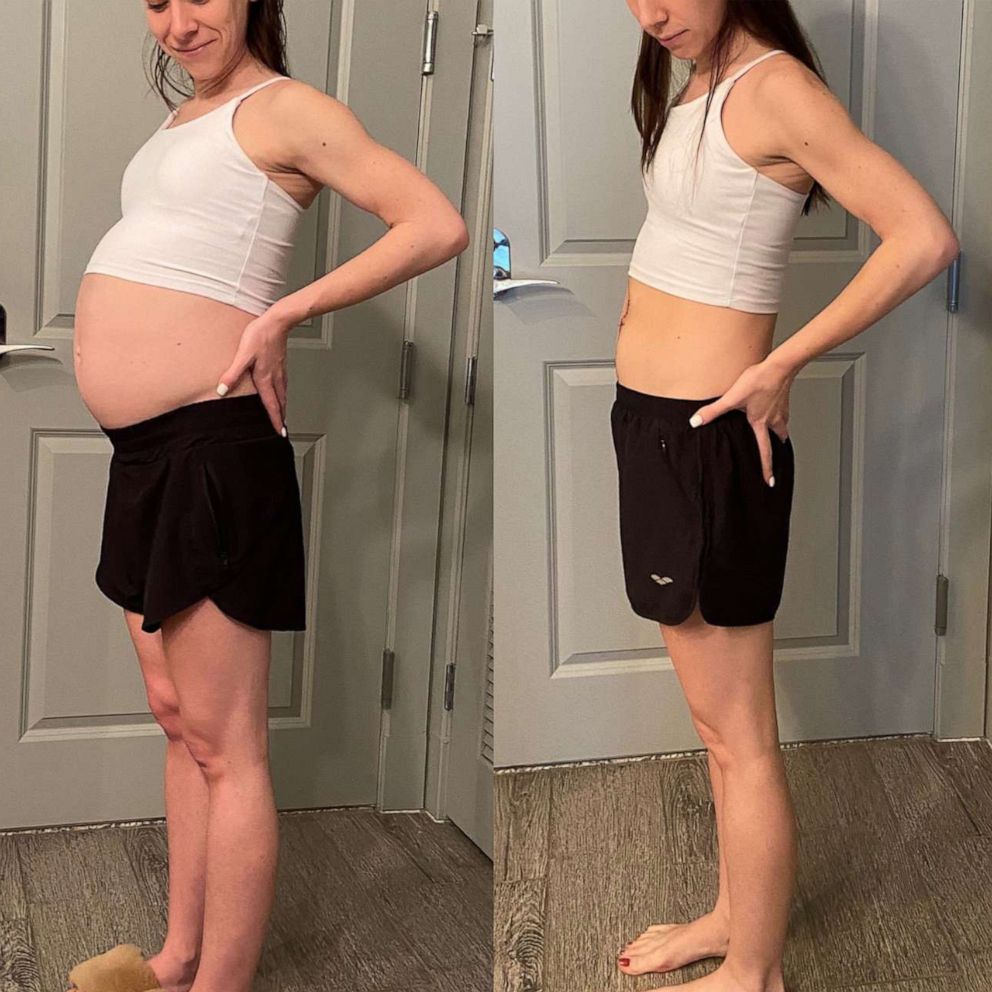 Woman Who Struggled For Months With Weight Gain Diagnosed With 17 pound 