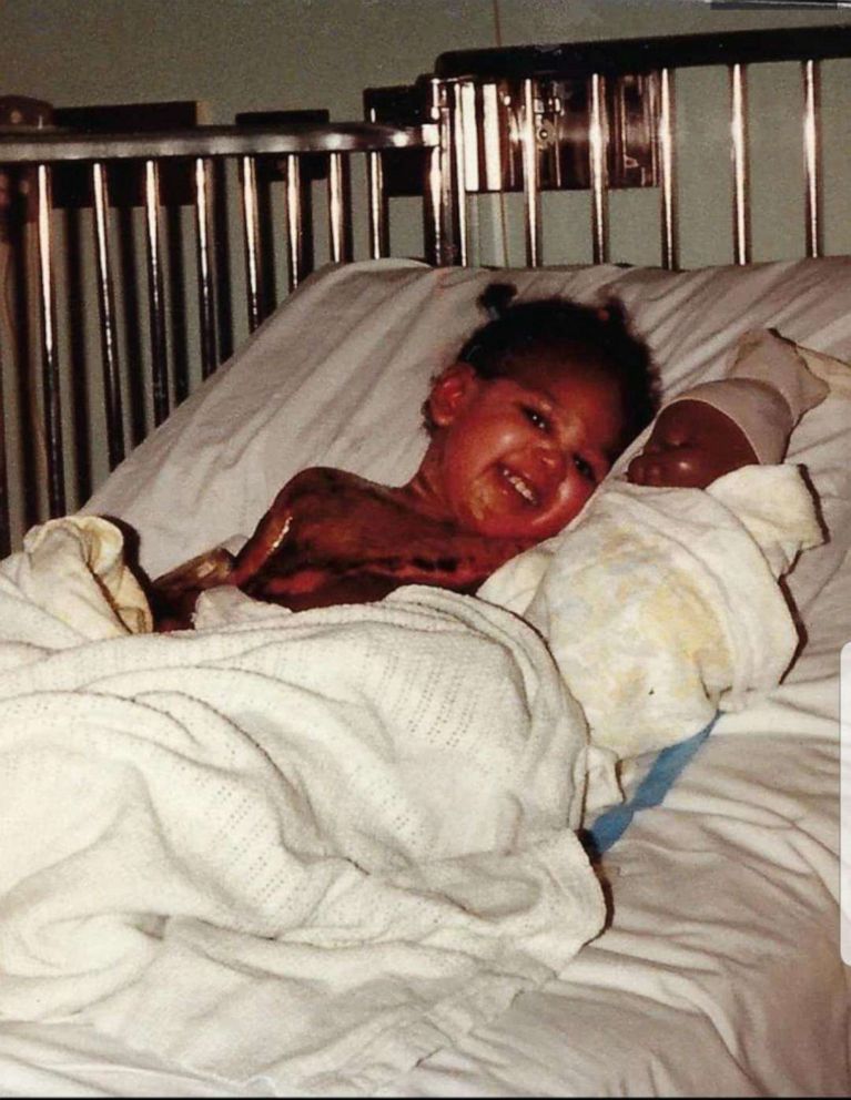 PHOTO: Andrea Pitts at 18 months old when she was hospitalized after pan of beans fell from the stove on her face and arms.