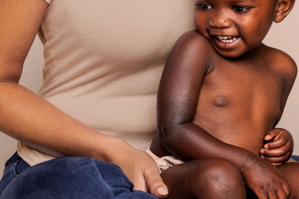 Aveeno Baby Provides Eczema Resources for Black Families