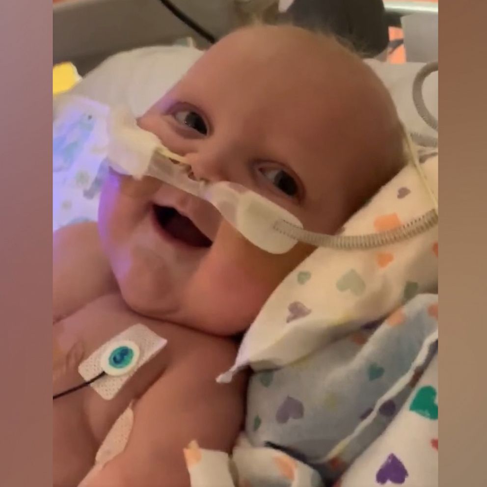 VIDEO: Baby who had two open-heart surgeries smiles for first time 