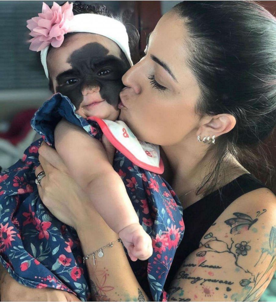 PHOTO: Luna Fenner was born with a congenital melanocytic nevus, which is a skin condition that shows a large marking on her face.