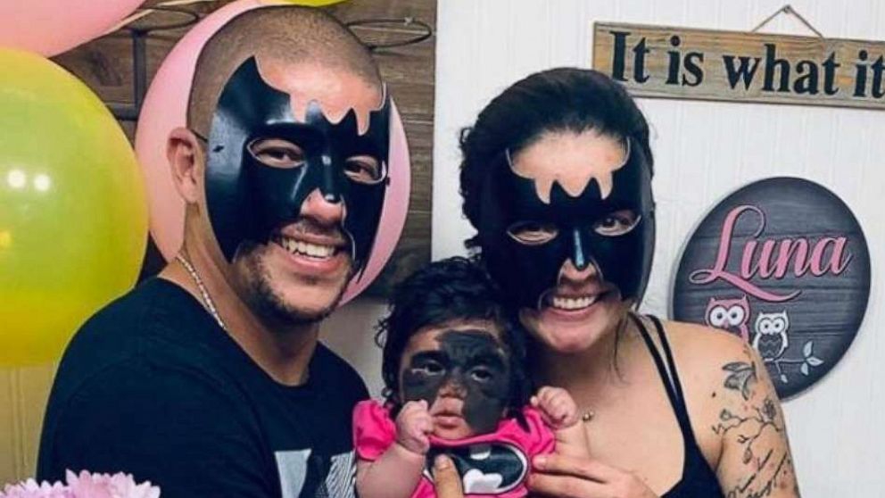 PHOTO: Luna Fenner was born with a congenital melanocytic nevus, which is a skin condition that shows a large marking on her face. Luna is pictured here with her parents Thiago and Carolina Fenner.