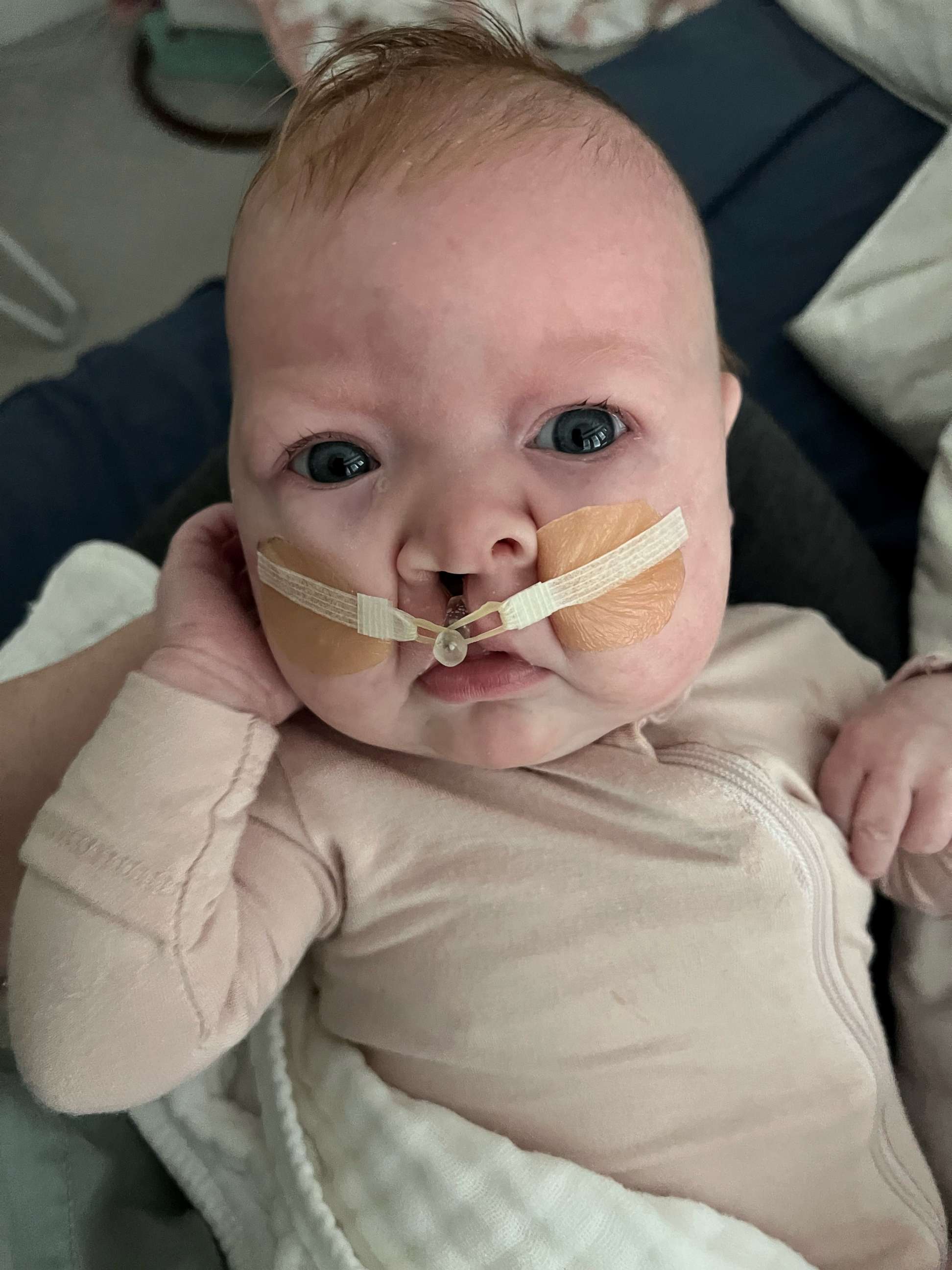 PHOTO: Sutton was diagnosed with a unilateral cleft lip and palate and will get surgery in the future to repair the defect in her lip.