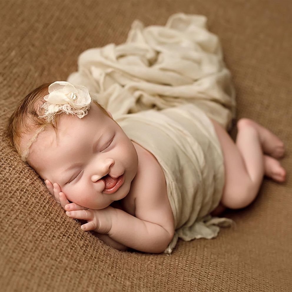 VIDEO: Newborn with cleft lip and palate has the sweetest photoshoot