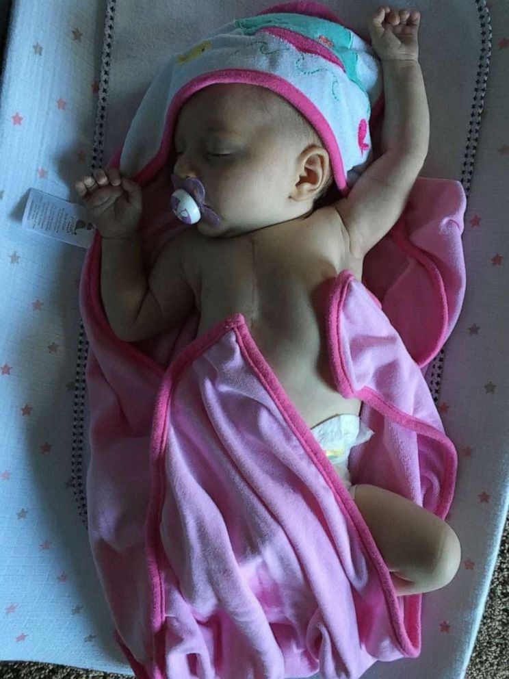 PHOTO: Everly Backe, now 4, underwent her first open heart surgery at 3 days old.