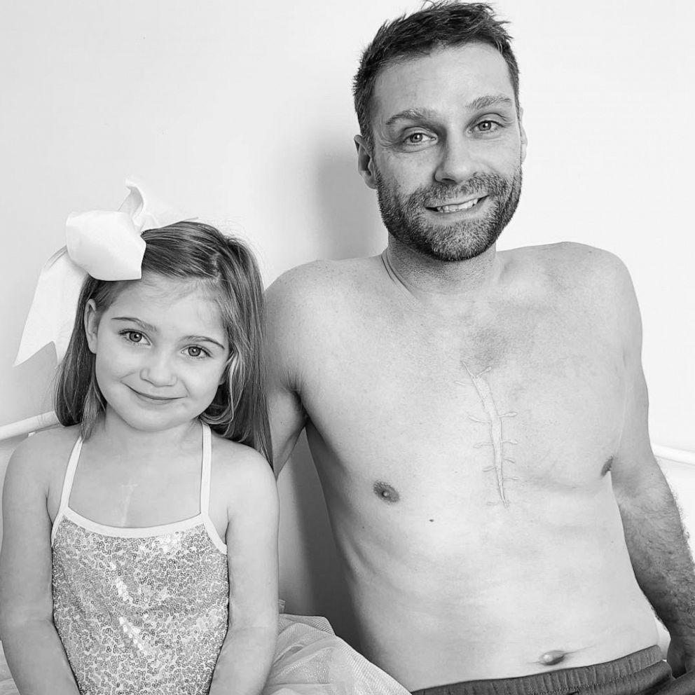 VIDEO: Dad gets 'zipper' tattoo to match 4-year-old daughter's heart surgery scars 