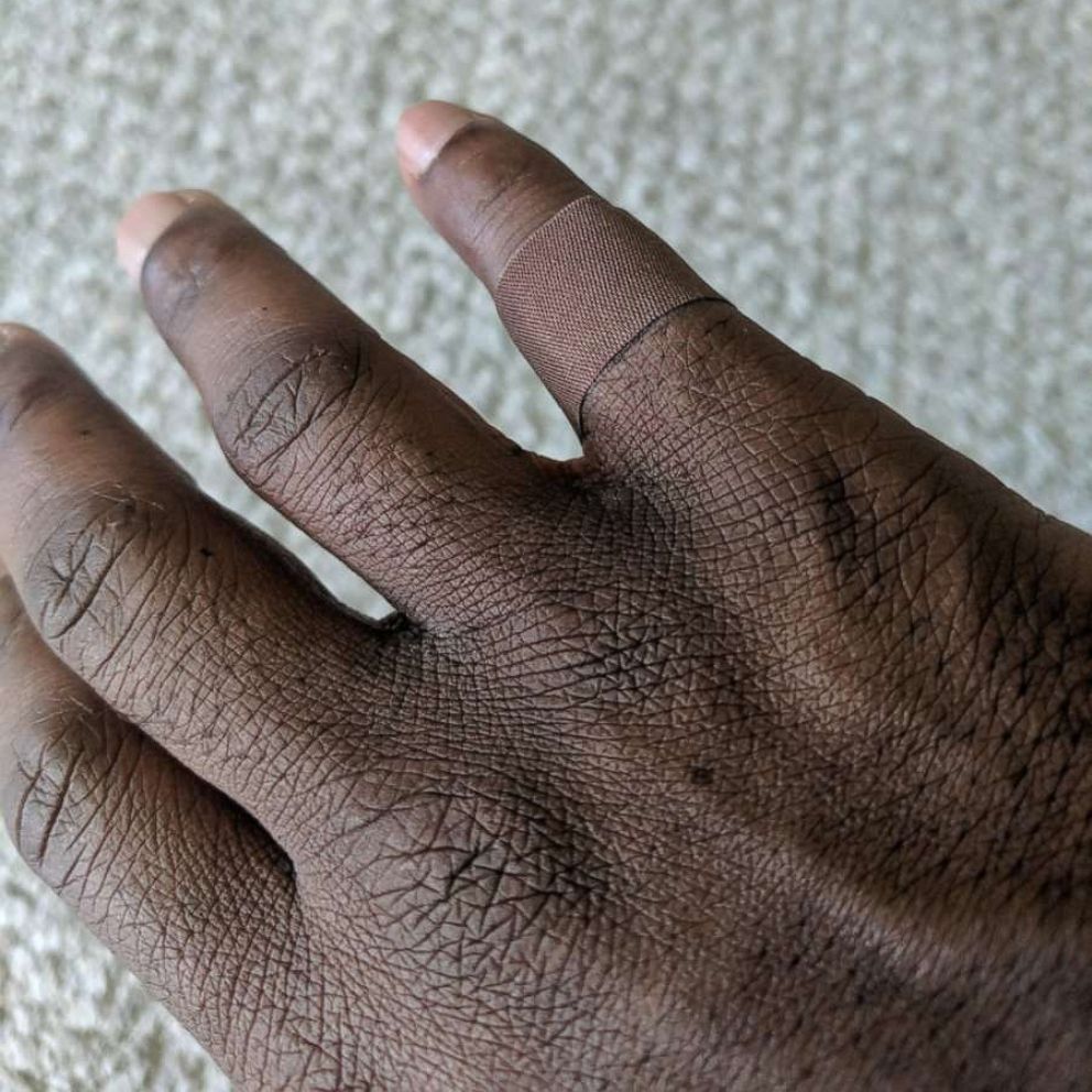 VIDEO: Man's powerful tweet showing a bandage that matched his skin draws global support 
