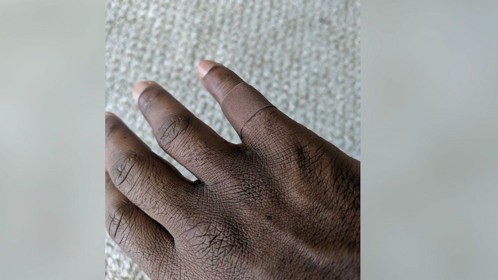 PHOTO: Dr. Dominique Apollon, 45, of San Francisco Bay, Calif., shared two photos of a bandage that matched his skin tone which received over half a million likes on Twitter.