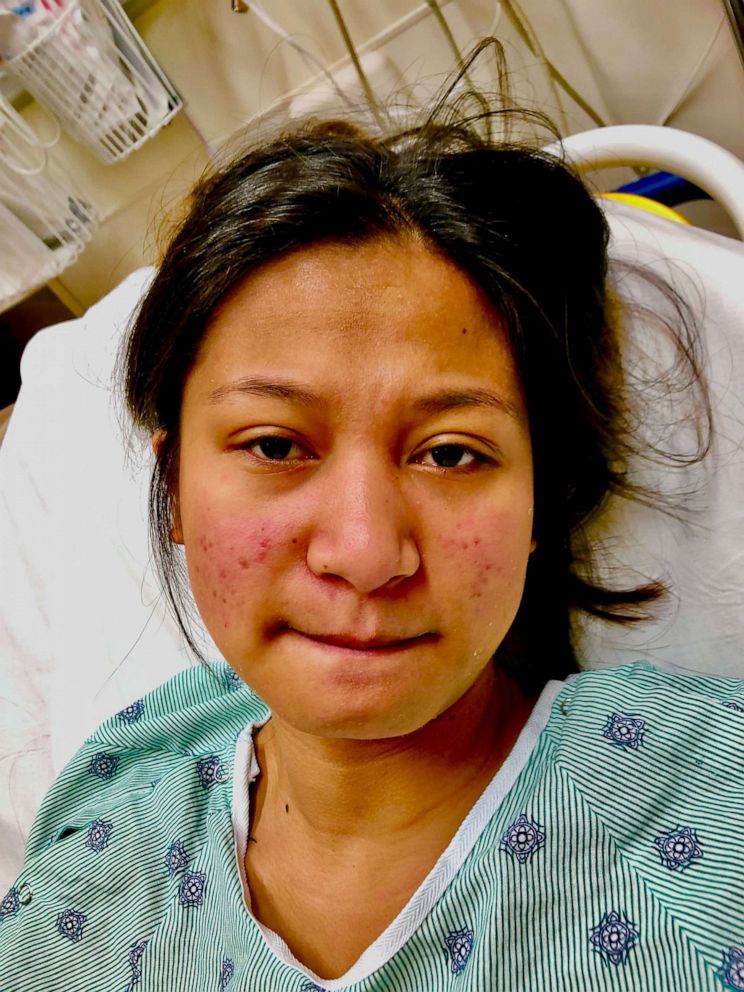 PHOTO: Viktoria Cupay had developed a butterfly rash and was rushed to an emergency room for medical care in June 2019.