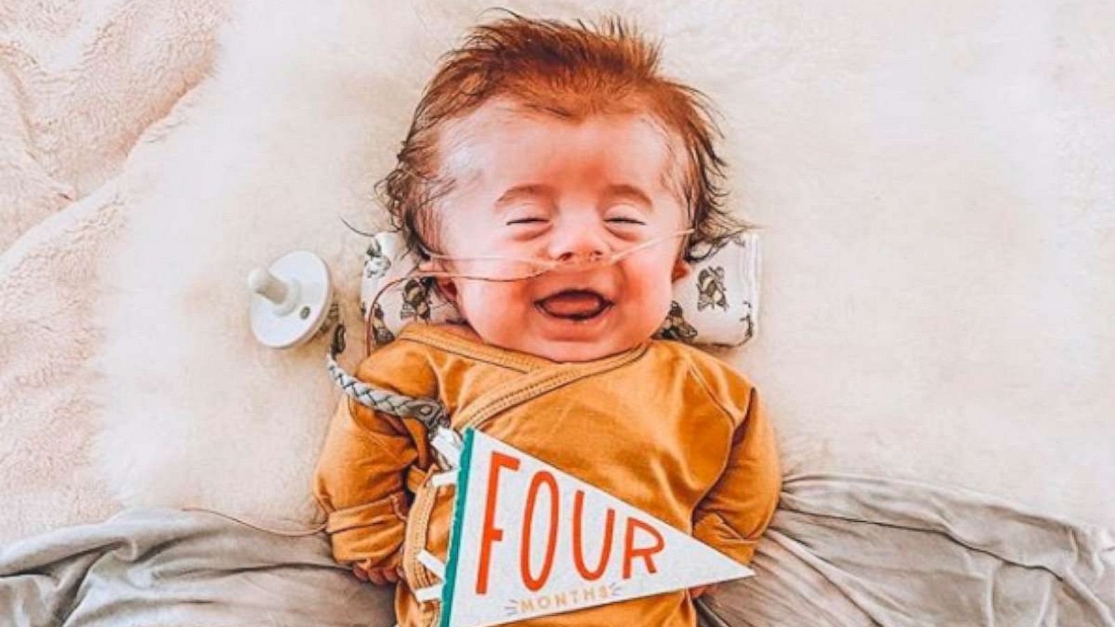 PHOTO: Jackson Storey was born with osteogenesis imperfecta (OI) on March 17, 2020 in Wichita, Kansas.