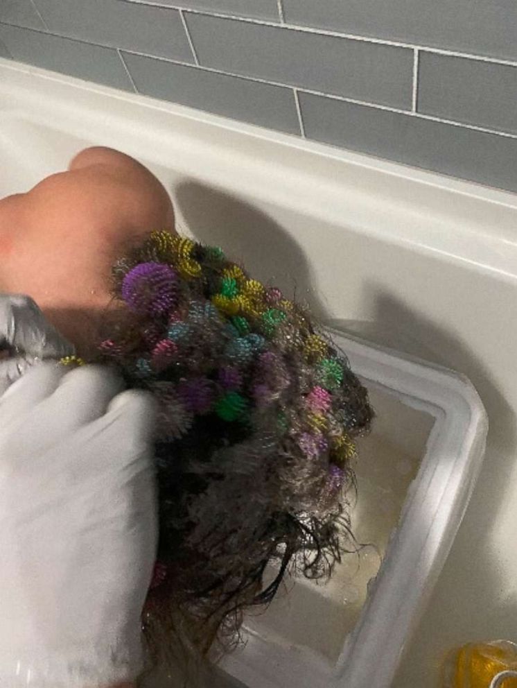 PHOTO: Lisa Hoelzle of Churchville, Pennsylvania, said it took roughly 20 hours to remove toys called Bunchems from her 7-year-old daughter Abigail's hair on Jan. 8.