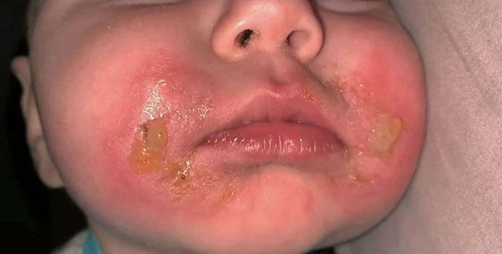 PHOTO: Reanna Bendzak's infant daughter experienced "margarita burn" after eating celery while outdoors in the sun.